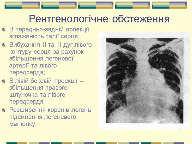 Рентгенологічне обстеження В передньо-задній проекції зглаженість талії серця; Вибухання ІІ та ІІІ дуг лівого